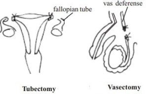 vasectomy